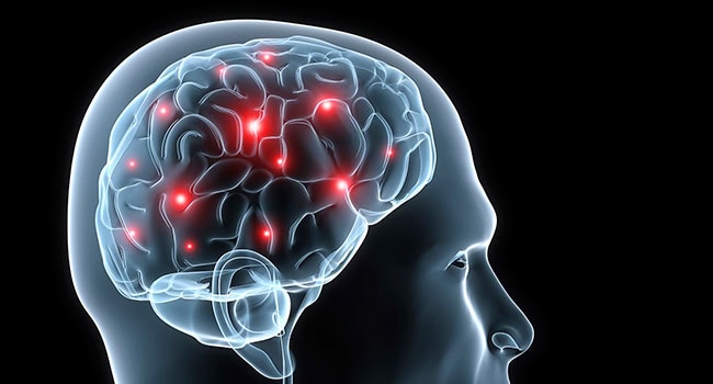 Ilustración de una cabeza humana que muestra una vista transparente del cerebro con puntos rojos que indican actividad neuronal en su interior, sobre un fondo negro, resaltando áreas potencialmente afectadas por la epilepsia.